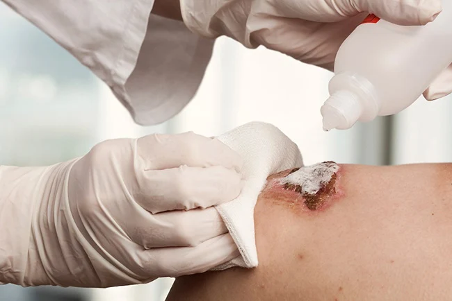 زخم بستر در سالمندان ( پیشگیری از زخم بستر در سالمندان + درمان )